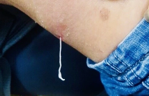 Đầu và một phần thân giun rồng chui ra từ nốt mụn sưng tấy trên đùi của người bệnh tại Yên Bái. ẢNH: TƯ LIỆU CDC TỈNH YÊN BÁI
