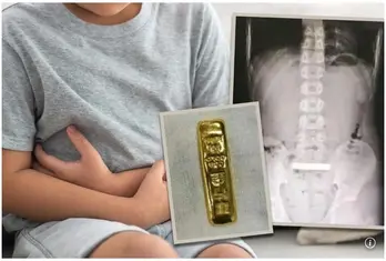 Cậu bé 11 tuổi nuốt thỏi vàng gần 3 lượng
