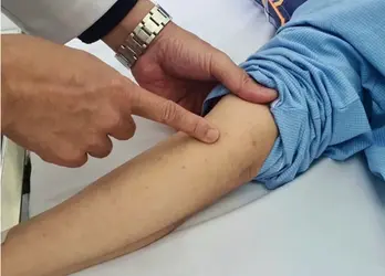Viêm não mô cầu: Dấu hiệu cảnh báo cần cấp cứu ngay