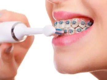 Ăn gì, vệ sinh răng thế nào khi đang niềng răng?