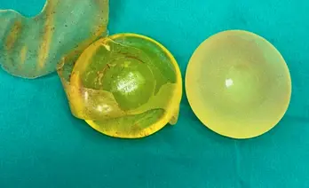 Rách túi ngực sau 22 năm nâng cấp vòng 1, silicon tràn ra khoang ngực
