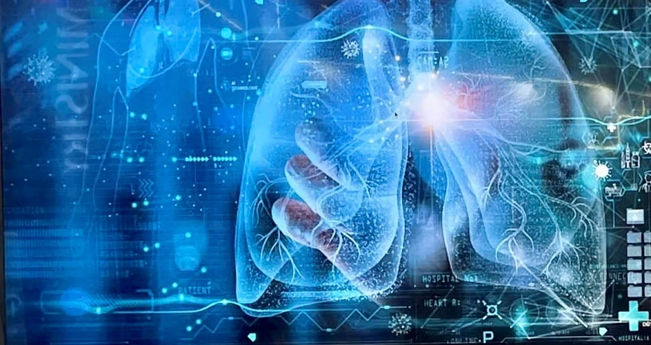 Ứng dụng AI chẩn đoán ung thư phổi