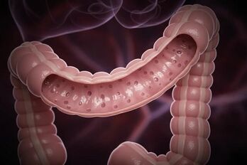 Ung thư đại tràng có di truyền không, phòng ngừa thế nào?